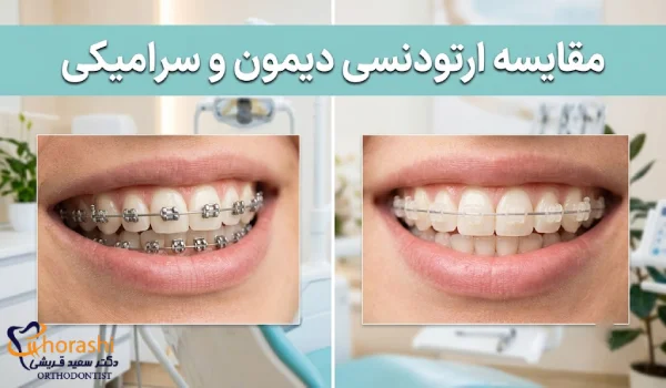 تفاوت ارتودنسی دیمون و سرامیکی