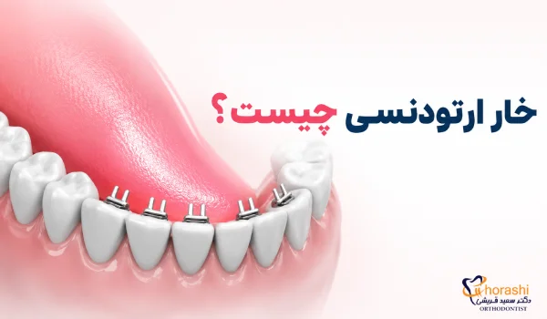 خار ارتودنسی چیست ؟