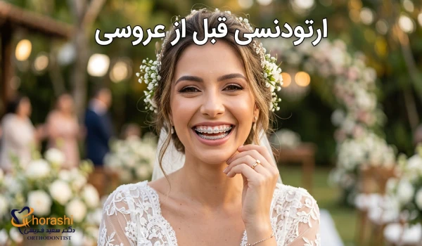 بهترین زمان برای ارتودنسی کردن قبل عروسی