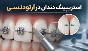 استریپینگ دندان در ارتودنسی