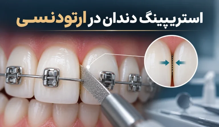 استریپینگ دندان در ارتودنسی