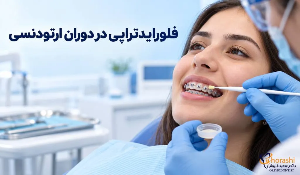 فلورایدتراپی در دوران ارتودنسی
