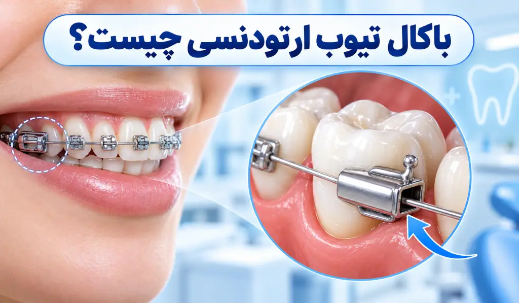 باکال تیوب ارتودنسی چیست؟