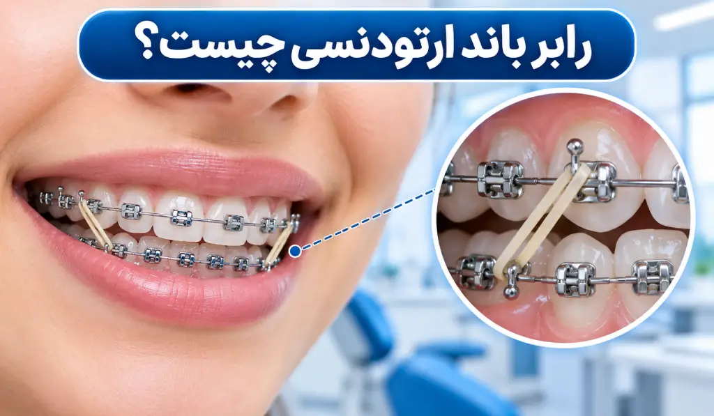 رابر بند ارتودنسی چیست