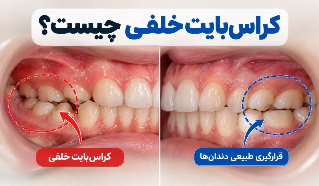 کراس بایت خلفی چیست