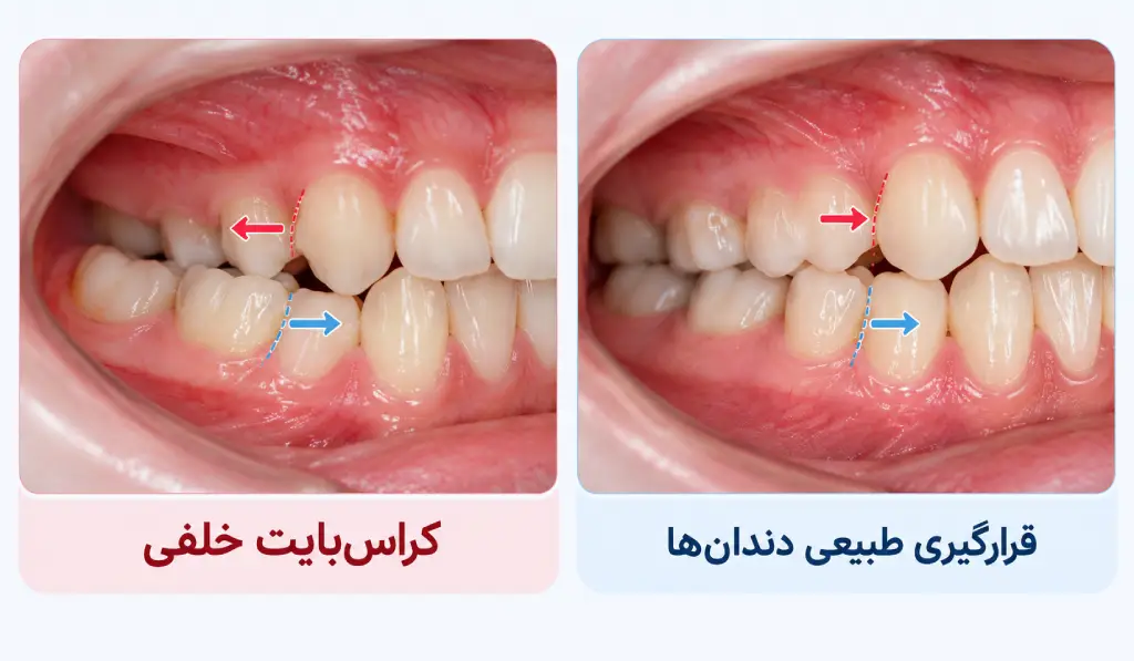 عکس کراس بایت خلفی