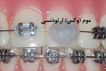 نحوه استفاده از موم ارتودنسی چیست