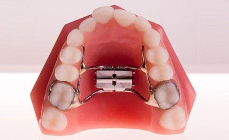 overbiteortho10