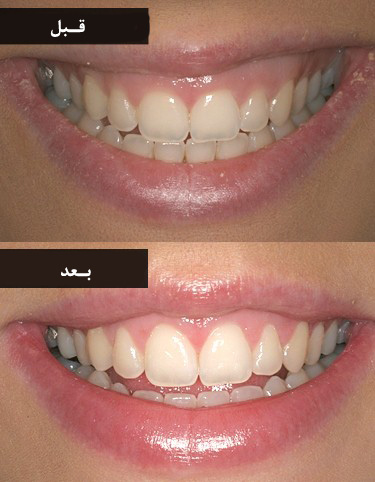 عکس جراحی لثه قبل و بعد