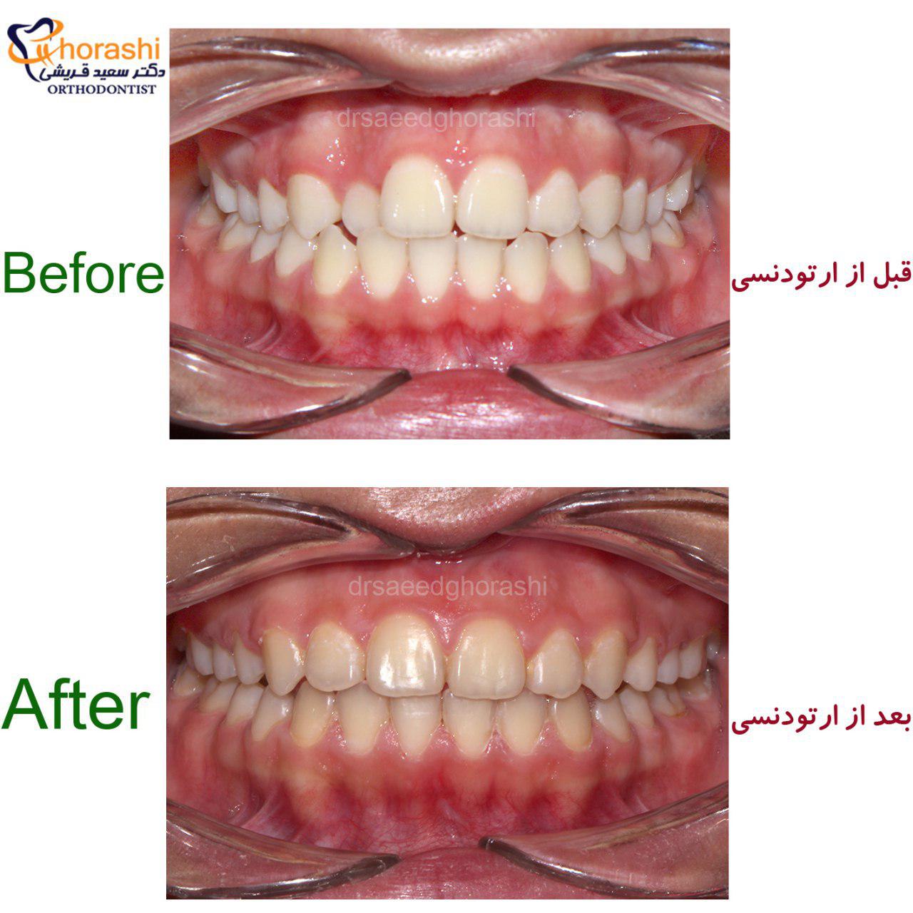 تاثیر ارتودنسی در بزرگسالی