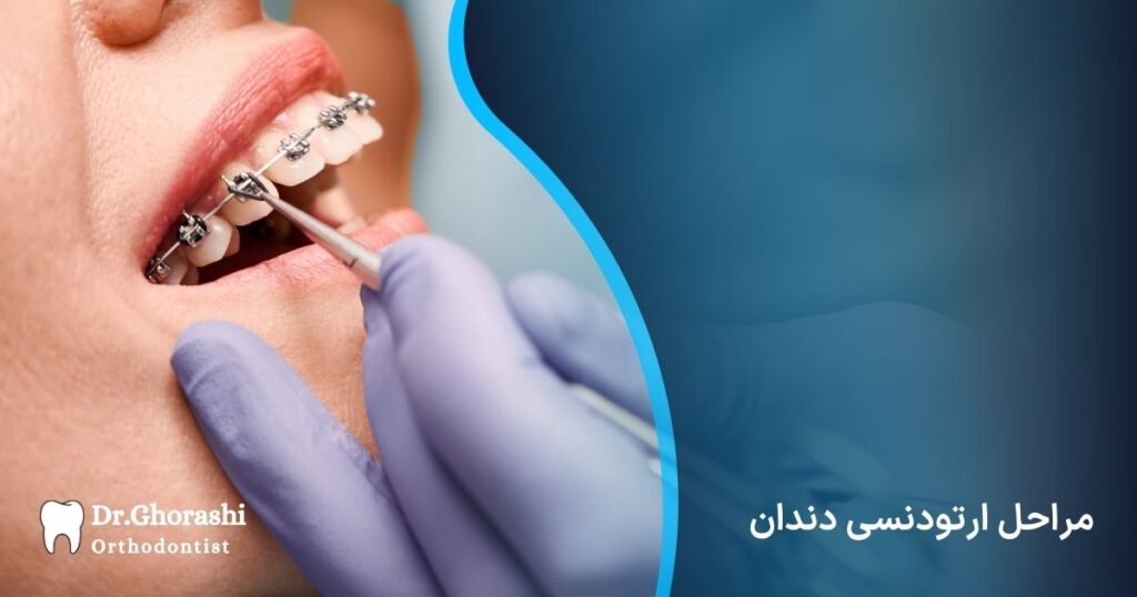 مراحل ارتودنسی دندان