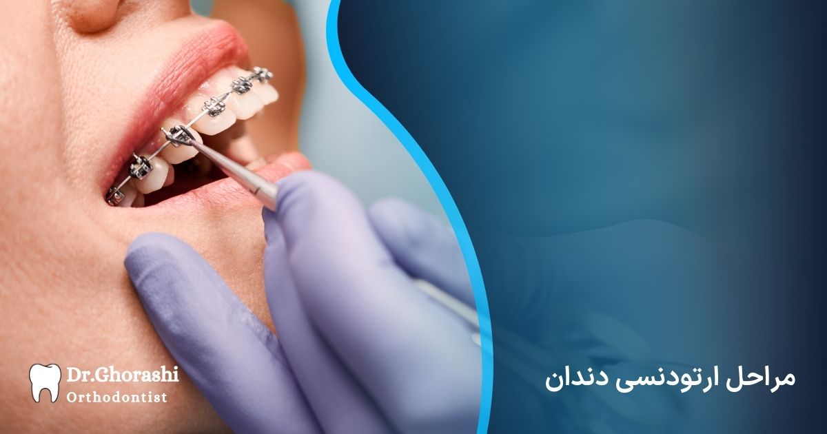 مراحل ارتودنسی دندان