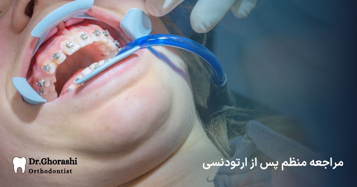 مرحله بعد از کش ارتودنسی