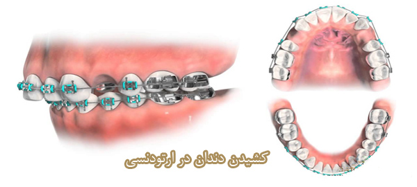 کشیدن دندان در ارتودنسی