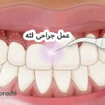 جراحی لثه
