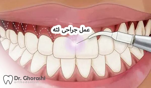 جراحی لثه