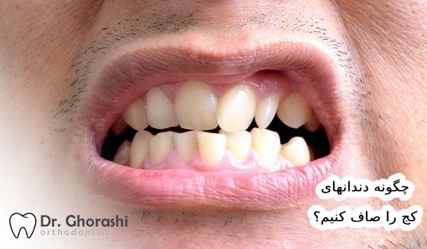 چگونه دندان کج را صاف کنیم