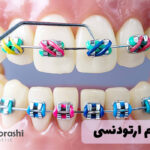 انواع سیم ارتودنسی
