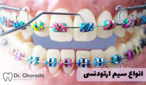 انواع سیم ارتودنسی