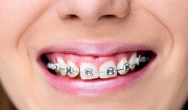 نصب بریس روی یک فک برای ارتودنسی یک دندان