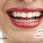 از بین بردن فاصله دندان در خانه