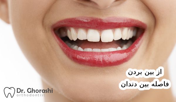 از بین بردن فاصله دندان در خانه