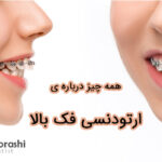 همه چیز درباره ی ارتودنسی فک بالا