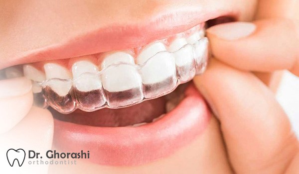 تاثیر نوع بریس بر شرایط اقساط درمان ارتودنسی