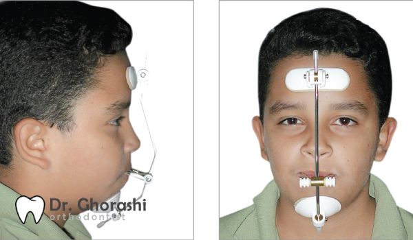 نحوه گذاشتن ماسک ارتودنسی روی صورت
