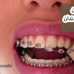 برداشتن ارتودنسی دندان