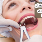آیا کشیدن دندان عقل ضروری است