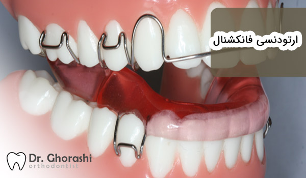 ارتودنسی فانکشنال