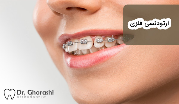 ارتودنسی فلزی