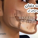 آندربایت دندان