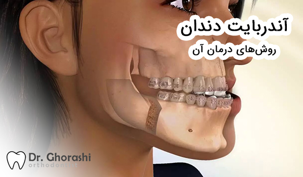 آندربایت دندان