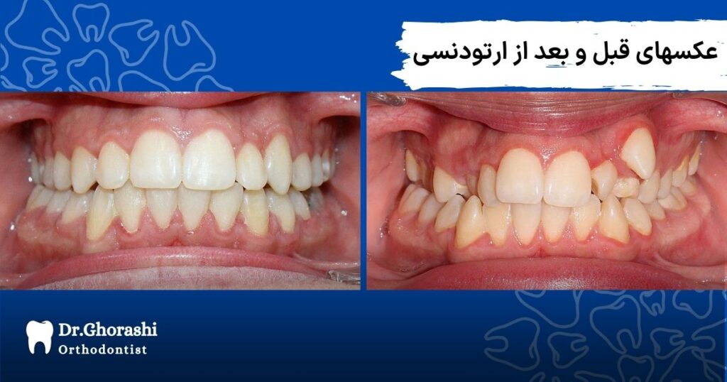 عکسهای قبل و بعد ارتودنسی