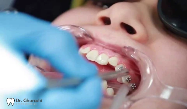 باندینگ ارتودنسی