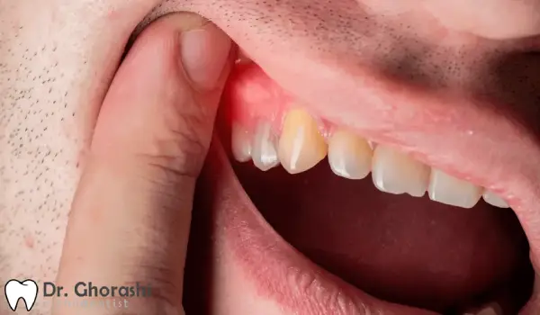 شرایط لازم لثه قبل از ارتودنسی