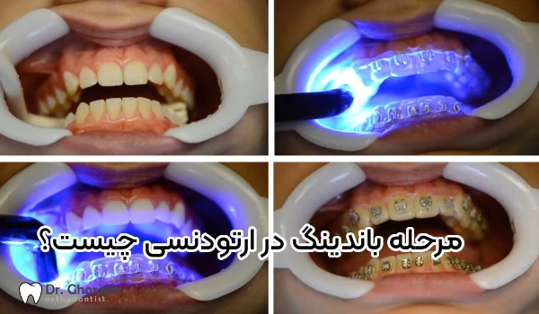 مرحله باندینگ در ارتودنسی چیست