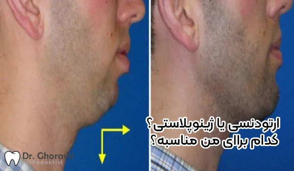 ژنیوپلاستی یا ارتودنسی