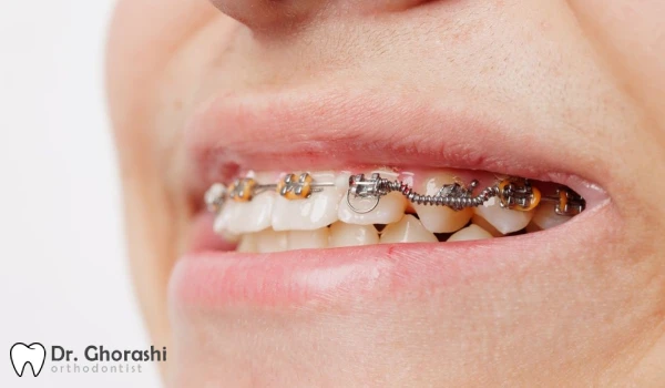 بلعیدن براکت ارتودنسی