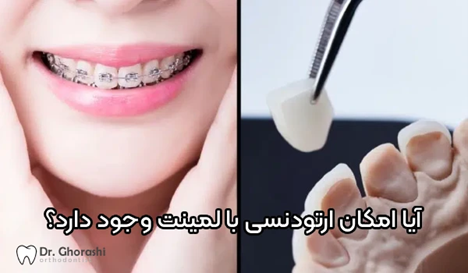 ارتودنسی دندان لمینت شده