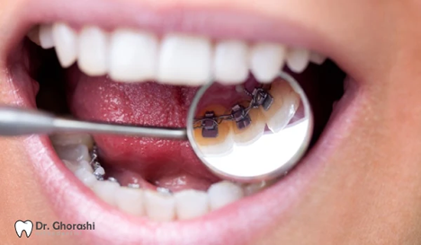 بهترین روش های ارتودنسی دندان لمینت شده