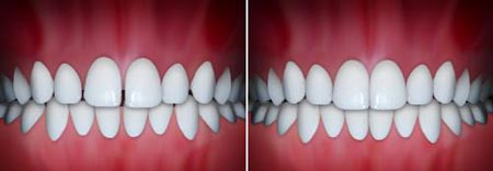 overbiteortho3