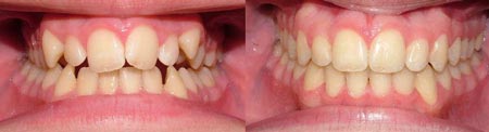 overbiteortho4