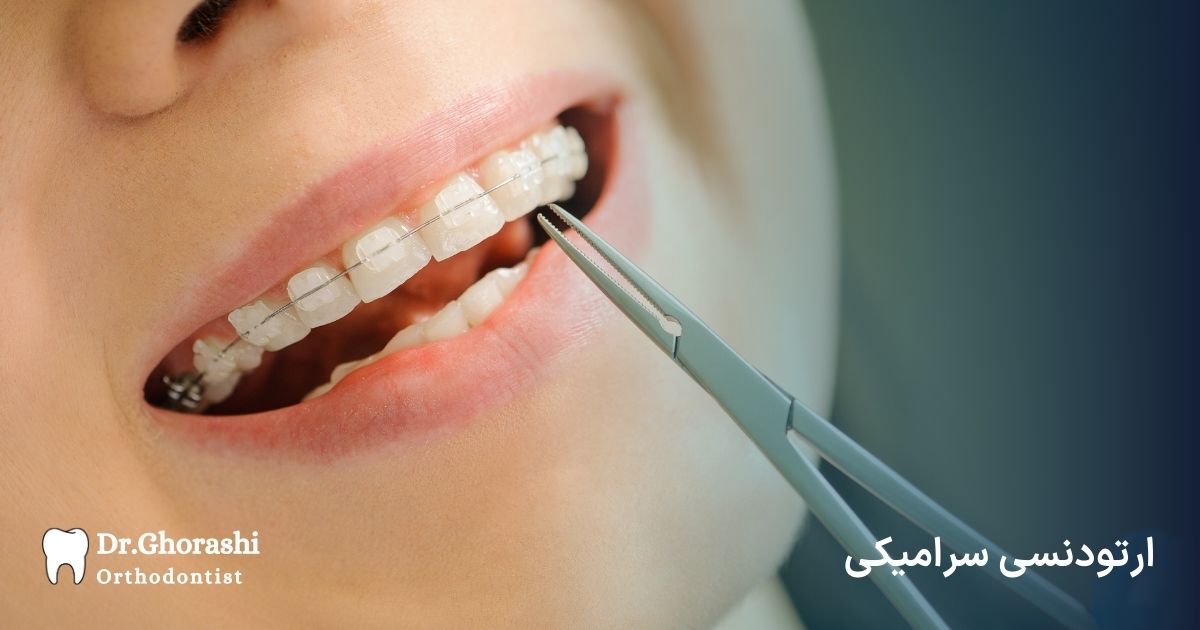 ارتودنسی سرامیکی