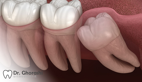 کج درآمدن دندان عقل