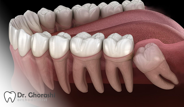 دندان عقل کج