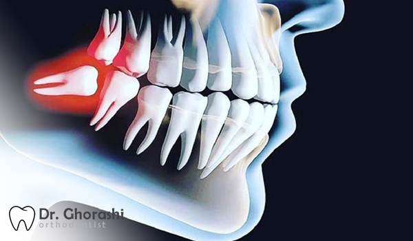 کشیدن دندان عقل کج پایین
