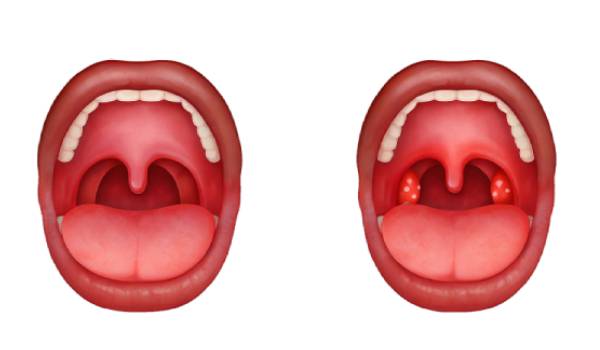 عکس لوزه سالم و ناسالم